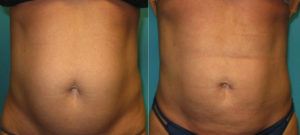 abdomen liposuction cincinnati