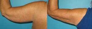 arm liposuction, Vaser liposuction cincinnati Transform Medspa