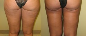 thigh liposuction, Vaser liposuction cincinnati Transform Medspa